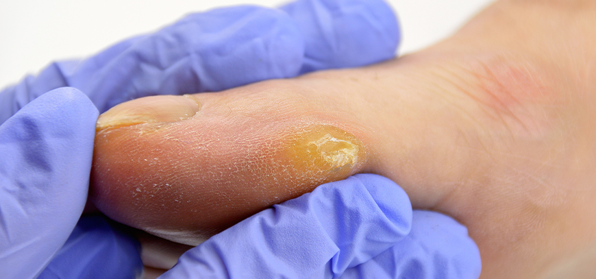 podologikokentroiliou-ipiresies-yperkeratwseis-hero