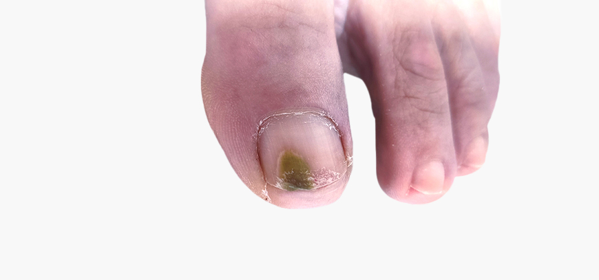 podologikokentroiliou-ipiresies-onyxomykitiaseiss-hero-3